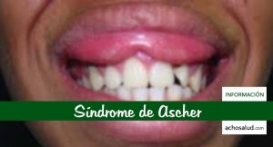 Síndrome de Ascher